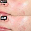 Kiehl’s Truly Targeted Acne-Clearing Pimple Patch with 2% Salicylic Acid, Invisible Liquid Spot Treatment, 4% Niacinamide Fades Post-Acne Marks, 0.2% Licorice Root Soothes Redness – 0.5 fl oz